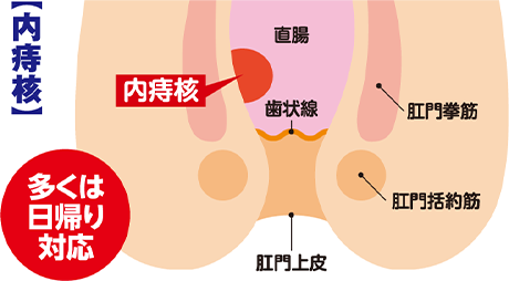 内痔核