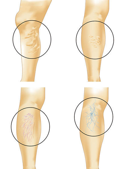 下肢静脈瘤とは Varicose vein