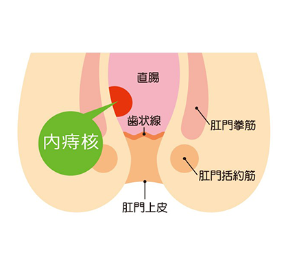 いぼ痔(内痔核)の日帰り手術いぼ痔もお尻の”静脈瘤”です