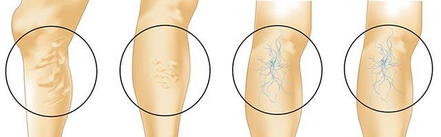 下肢静脈瘤とは Varicose vein