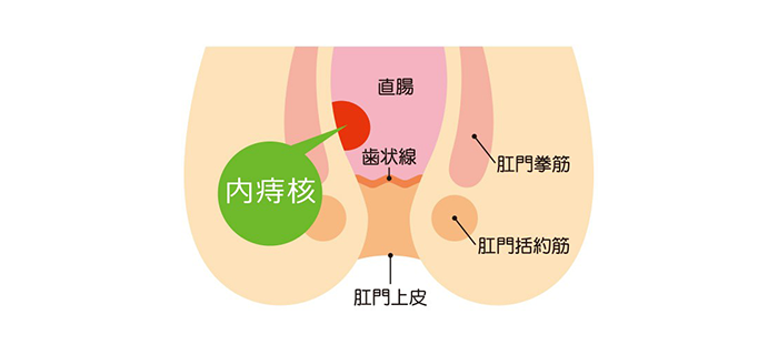 いぼ痔(内痔核)の日帰り手術いぼ痔もお尻の”静脈瘤”です