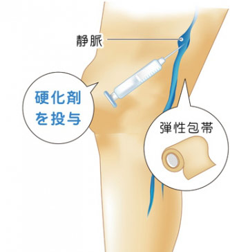 硬化療法とは